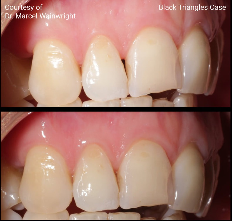 NEW! Intraoral Application of Hyaluronic Acid International